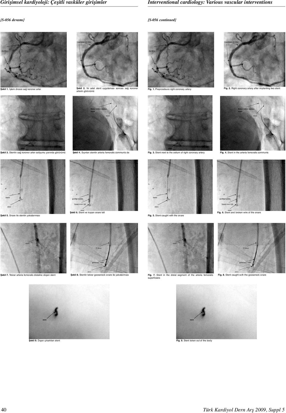 Stentin sağ koroner arter ostiyumu yanında görünümü Şekil 4. Sıyrılan stentin arteria femoralis communis de Fig. 3. Stent next to the ostium of right coronary artery Fig. 4. Stent in the arteria femoralis communis Şekil 6.