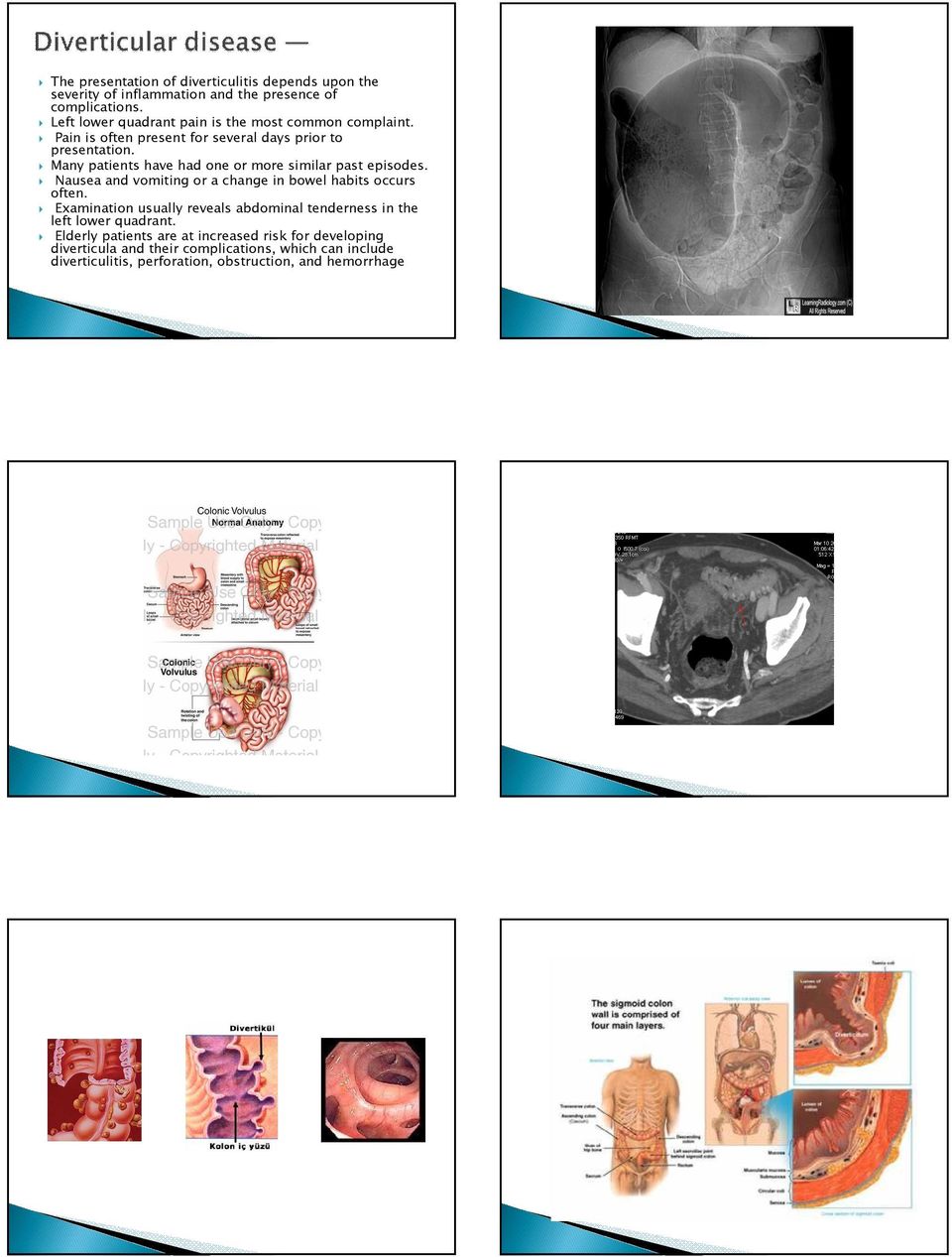 Many patients have had one or more similar past episodes. Nausea and vomiting or a change in bowel habits occurs often.