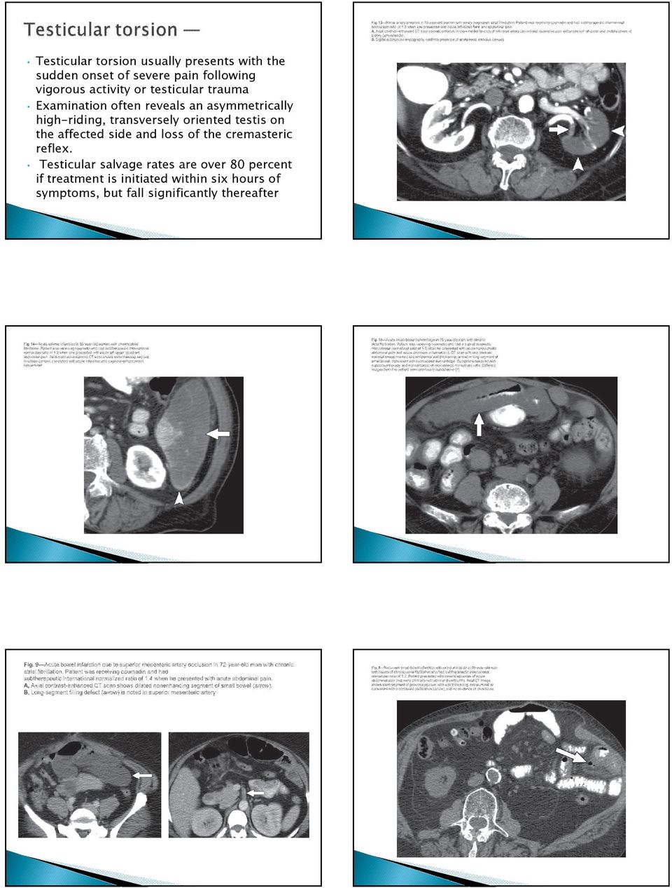 oriented testis on the affected side and loss of the cremasteric reflex.