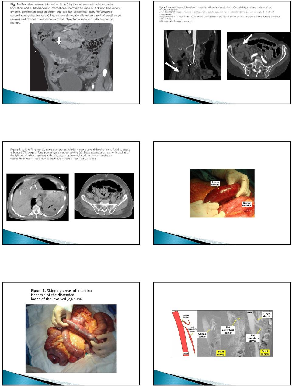 intestinal ischemia of