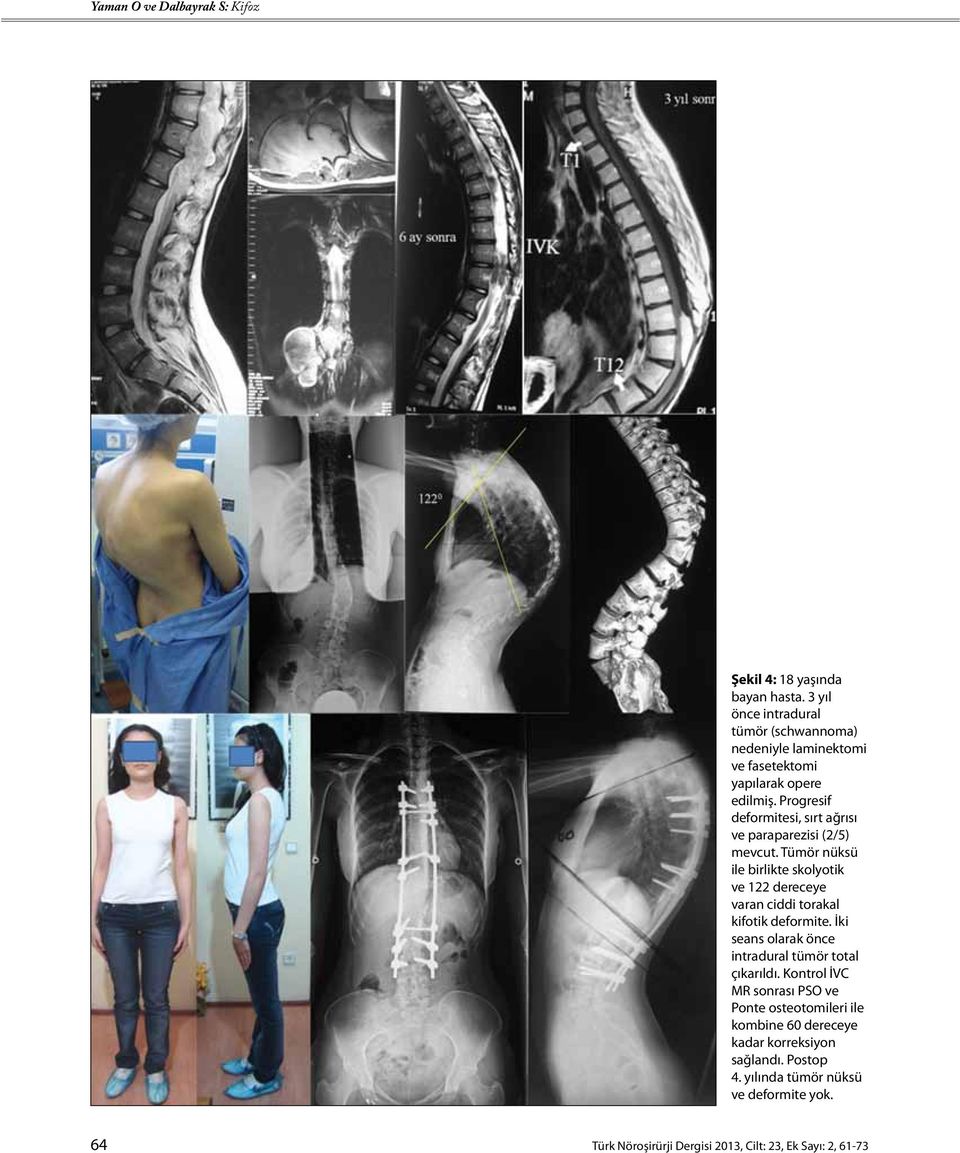 Tümör nüksü ile birlikte skolyotik ve 122 dereceye varan ciddi torakal kifotik deformite.