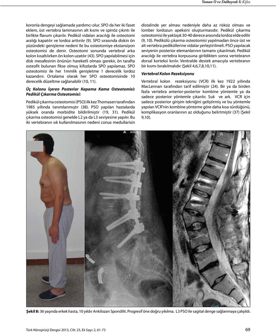 Osteotomi sonunda vertebral arka kolon kısaltılırken ön kolon uzatılır (43).