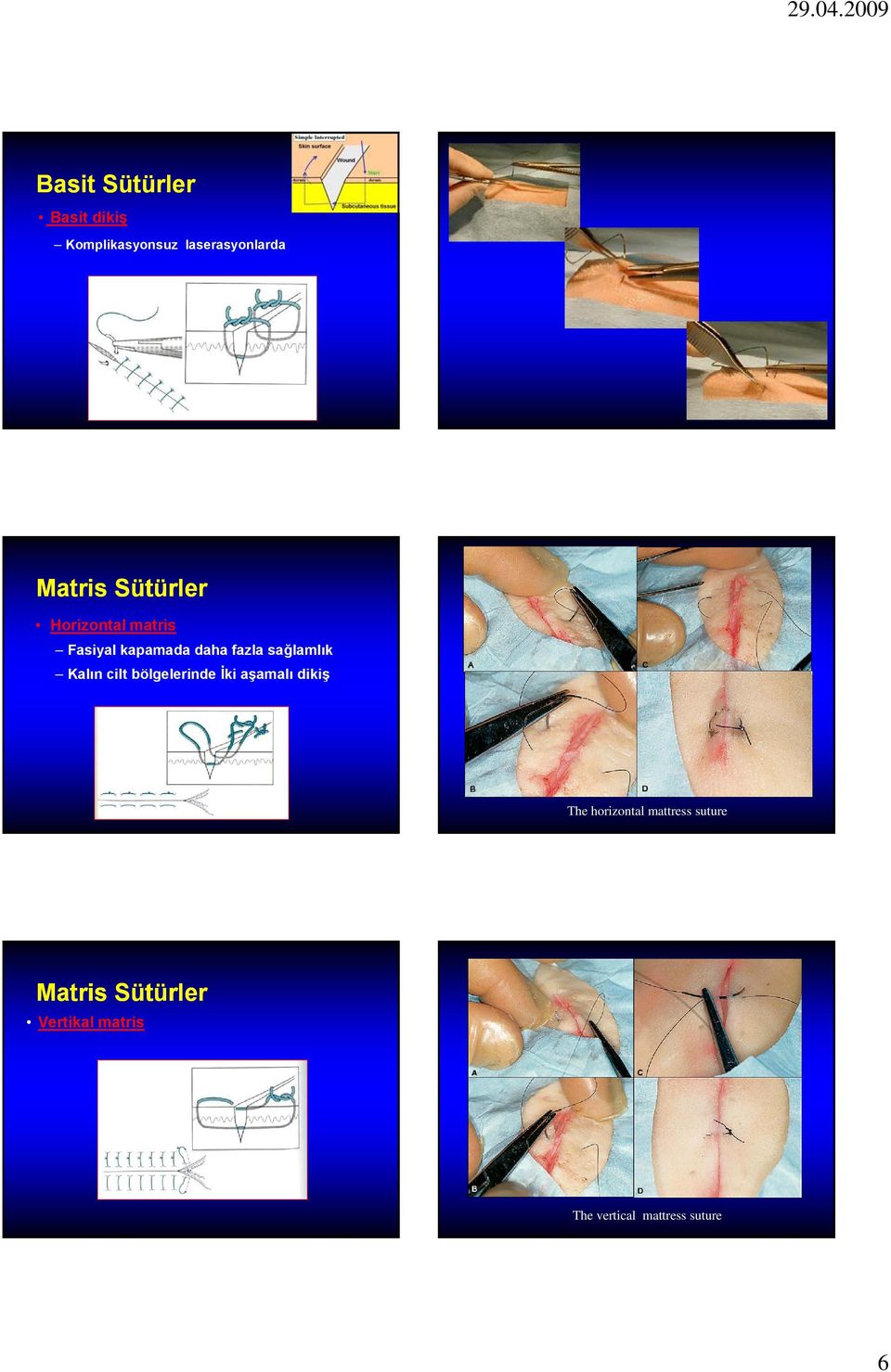 Kalın cilt bölgelerinde İki aşamalı dikiş The horizontal mattress