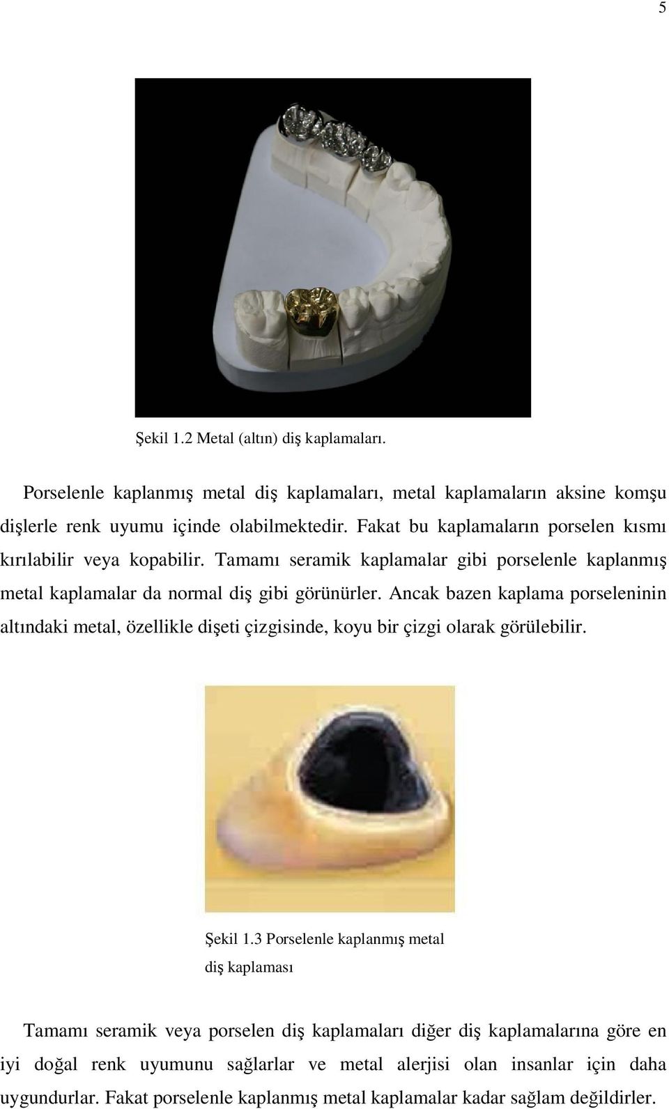 Ancak bazen kaplama porseleninin altındaki metal, özellikle dişeti çizgisinde, koyu bir çizgi olarak görülebilir. Şekil 1.