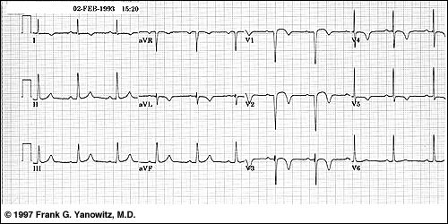 Anteroseptal