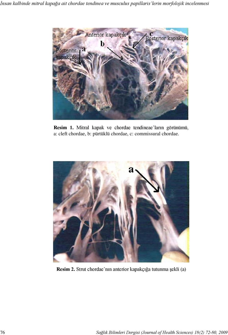 Mitral kapak ve chordae tendineae ların görünümü, a: cleft chordae, b: pürtüklü chordae,