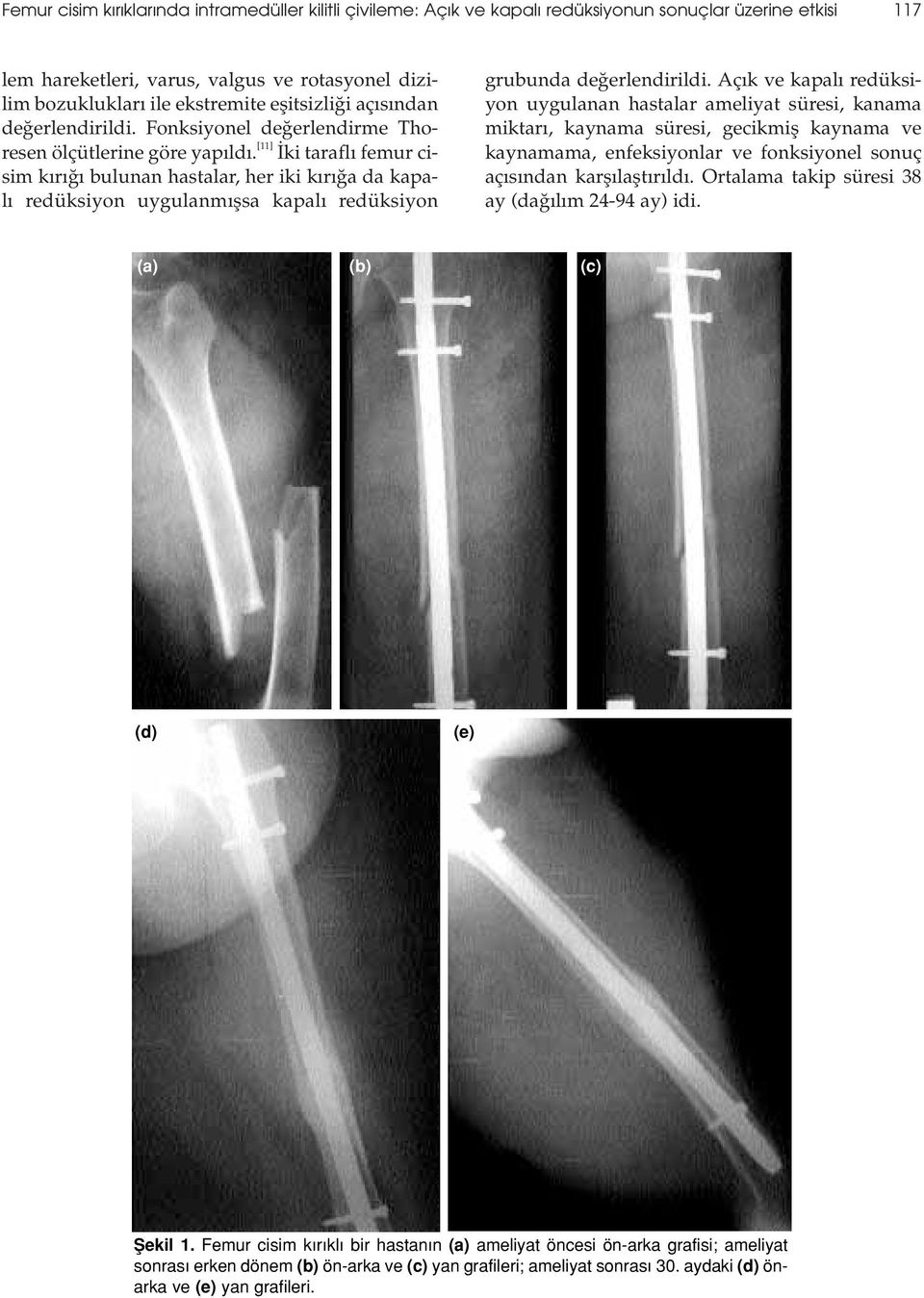 [11] ki tarafl femur cisim k r bulunan hastalar, her iki k r a da kapal redüksiyon uygulanm flsa kapal redüksiyon grubunda de erlendirildi.