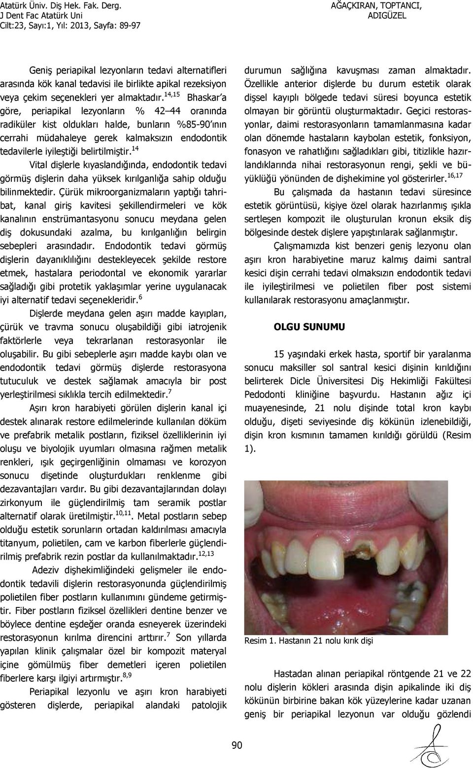 belirtilmiştir. 14 Vital dişlerle kıyaslandığında, endodontik tedavi görmüş dişlerin daha yüksek kırılganlığa sahip olduğu bilinmektedir.