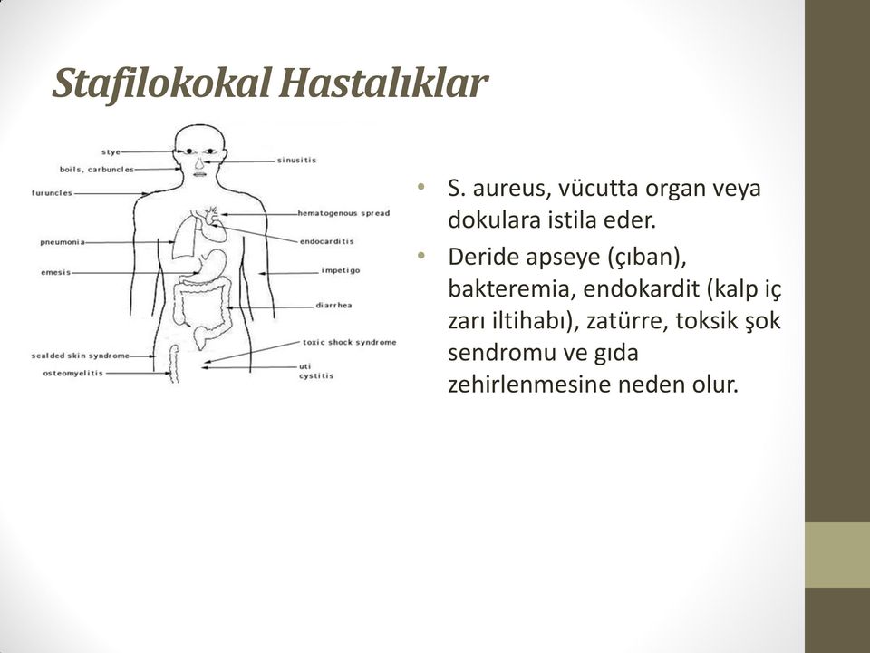 Deride apseye (çıban), bakteremia, endokardit (kalp