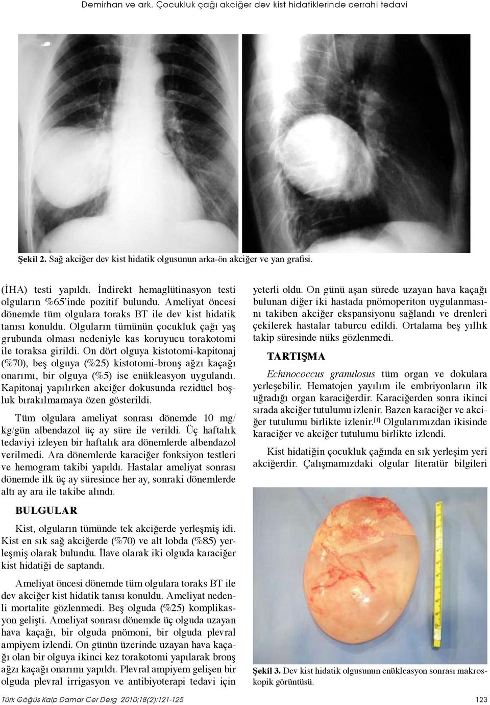 Olguların tümünün çocukluk çağı yaş grubunda olması nedeniyle kas koruyucu torakotomi ile toraksa girildi.