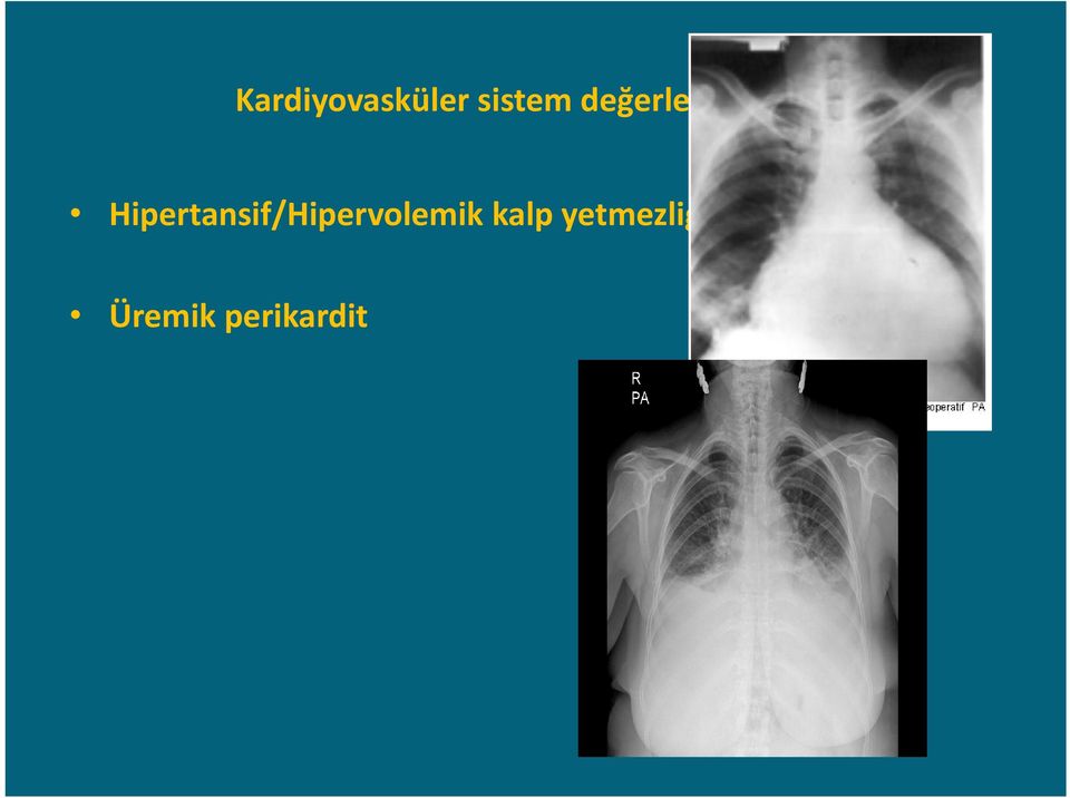 Hipertansif/Hipervolemik