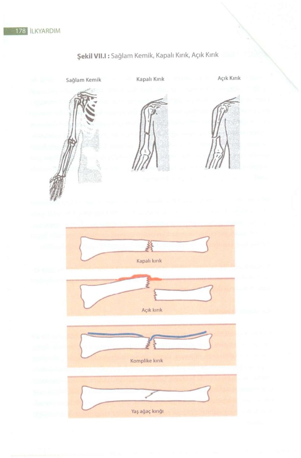 Kırık Sağlam Kemik Kapalı Kırık Açık