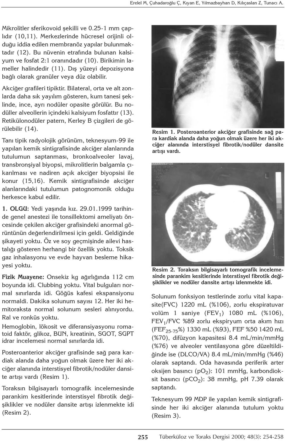 Dış yüzeyi depozisyona bağlı olarak granüler veya düz olabilir. Akciğer grafileri tipiktir.