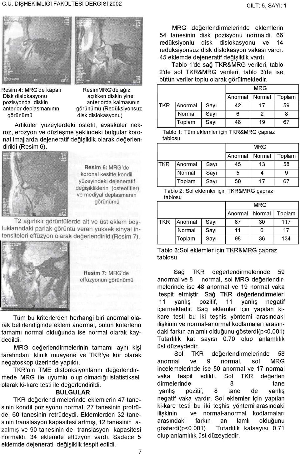 değerlendirildi (Resim 6). MRG değerlendirmelerinde eklemlerin 54 tanesinin disk pozisyonu normaldi. 66 redüksiyonlu disk dislokasyonu ve 14 redüksiyonsuz disk dislokasyon vakası vardı.