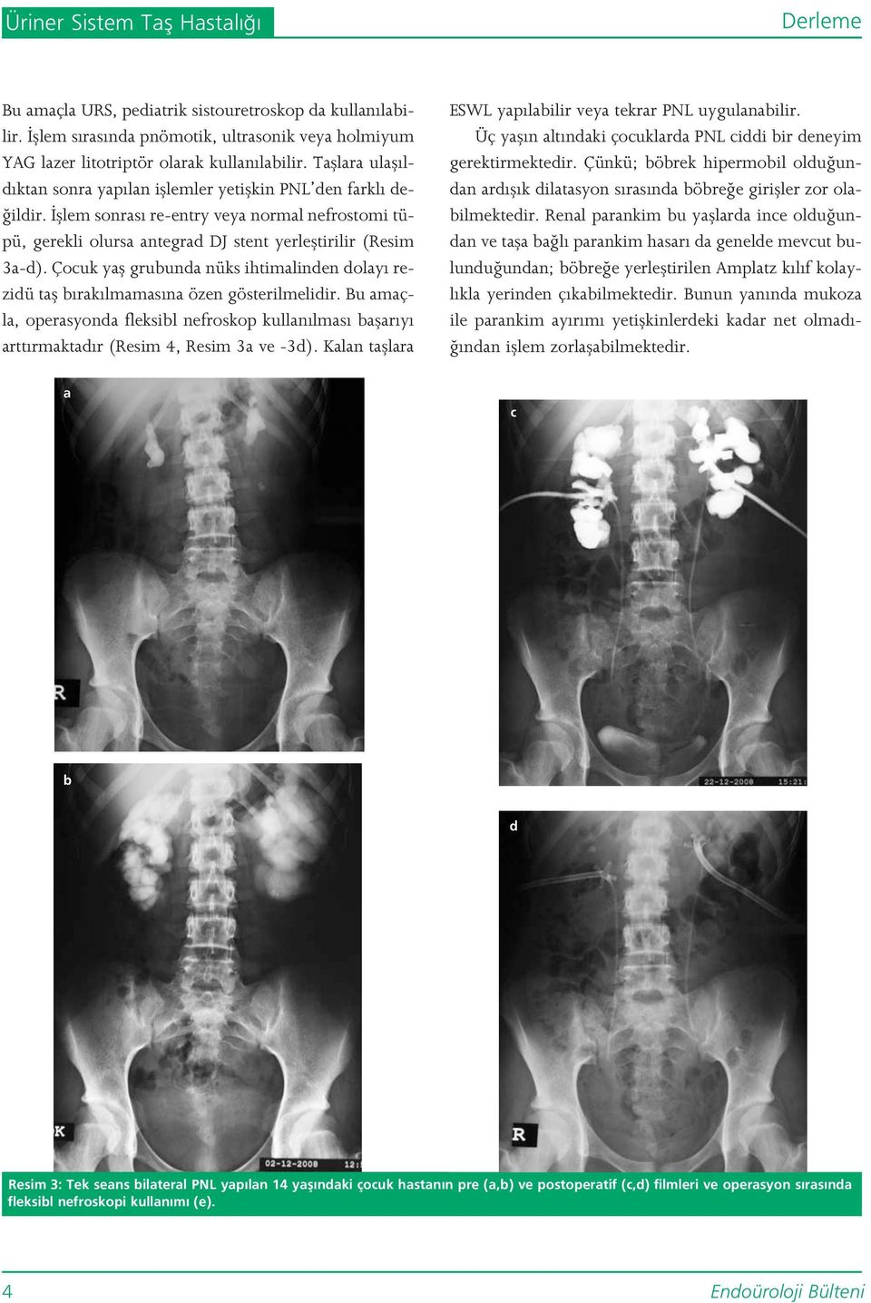 Çocuk yafl grubunda nüks ihtimalinden dolay rezidü tafl b rak lmamas na özen gösterilmelidir. Bu amaçla, operasyonda fleksibl nefroskop kullan lmas baflar y artt rmaktad r (Resim 4, Resim 3a ve -3d).