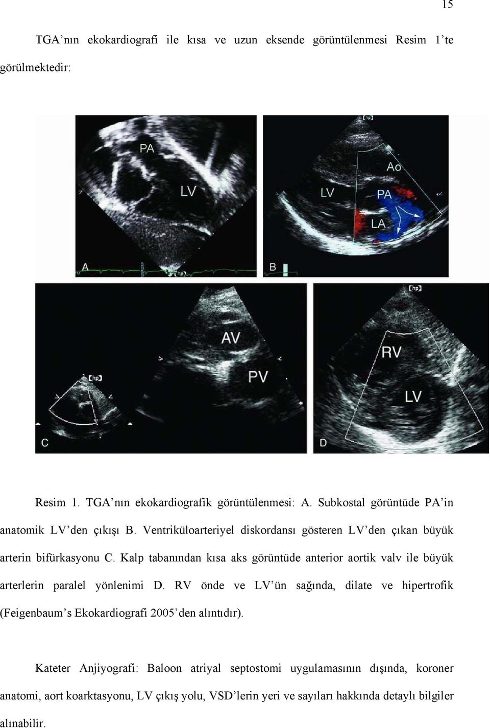 Kalp tabanından kısa aks görüntüde anterior aortik valv ile büyük arterlerin paralel yönlenimi D.