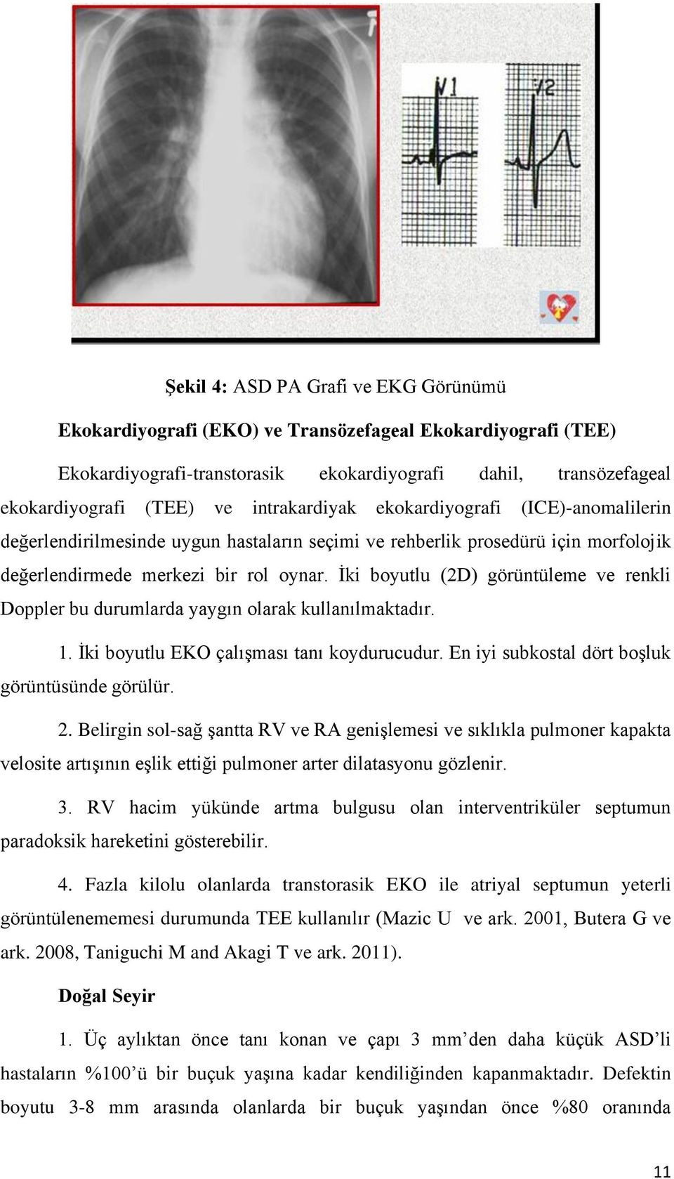 Ġki boyutlu (2D) görüntüleme ve renkli Doppler bu durumlarda yaygın olarak kullanılmaktadır. 1. Ġki boyutlu EKO çalıģması tanı koydurucudur. En iyi subkostal dört boģluk görüntüsünde görülür. 2.