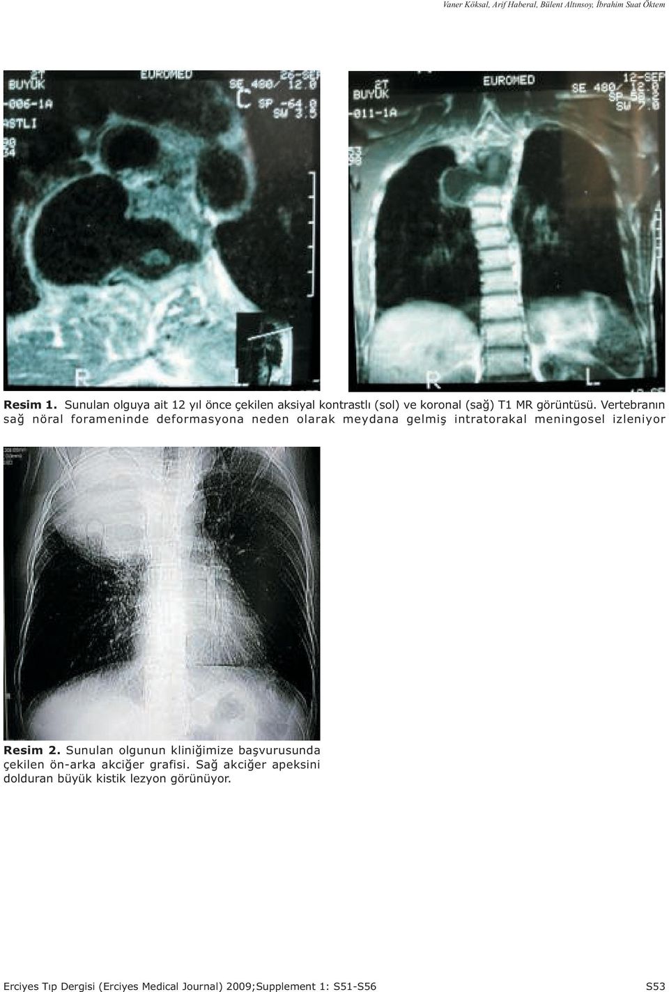 Vertebranýn sað nöral forameninde deformasyona neden olarak meydana gelmiþ intratorakal meningosel