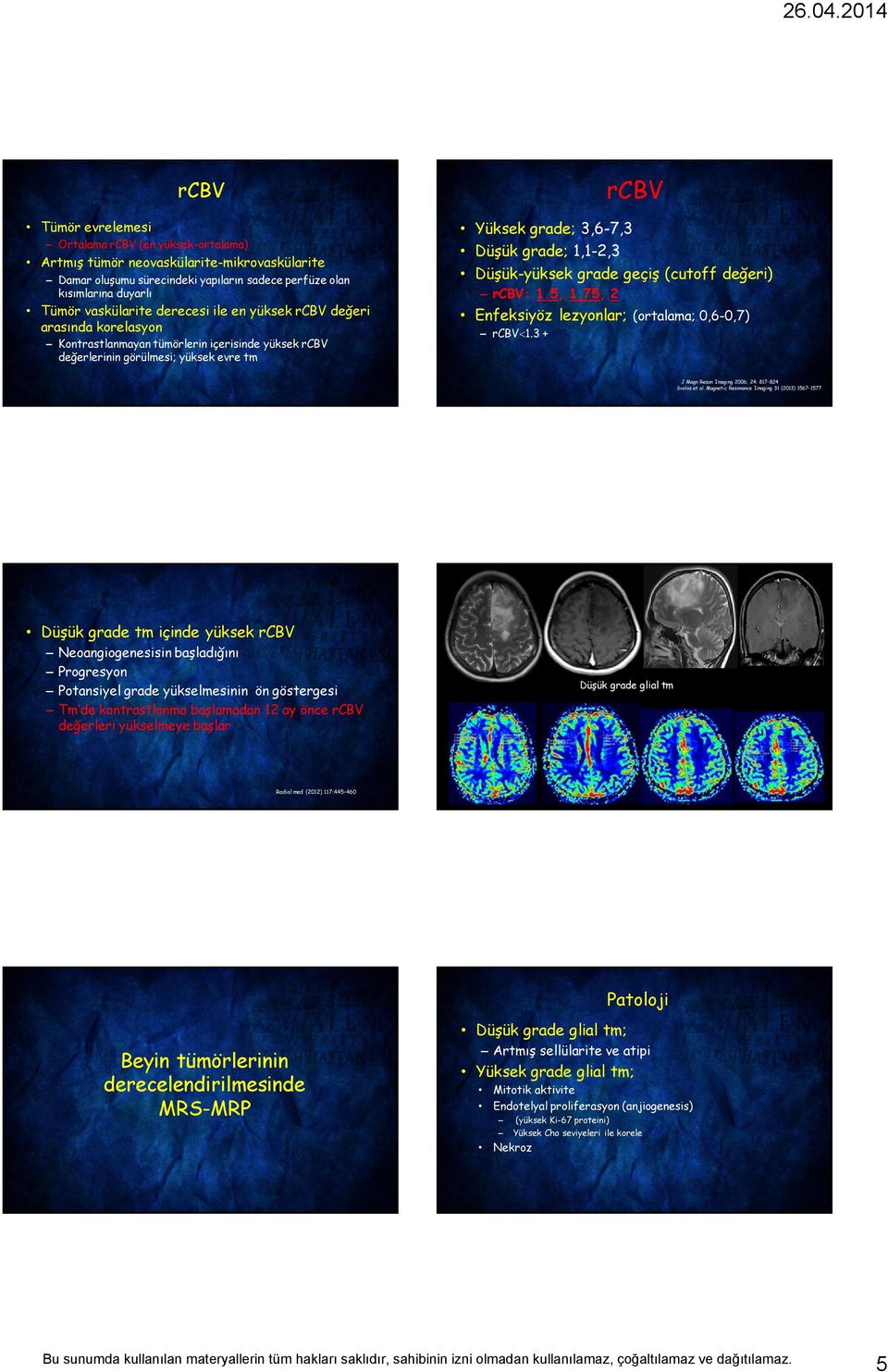 Düşük-yüksek grade geçiş (cutoff değeri) rcbv: 1.5, 1,75, 2 Enfeksiyöz lezyonlar; (ortalama; 0,6-0,7) rcbv 1.3 + J Magn Reson Imaging 2006; 24: 817 824 Svolos et al.