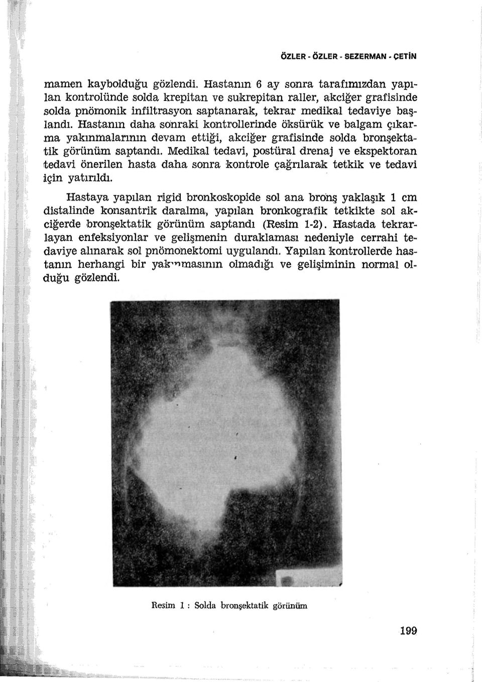 Hastanın daha sonraki kontrollerinde öksürük ve balgam çıkarma yakınmalarının devam ettiği, akciğer grafisinde solda bronşekta~ tik görünüm saptandı.