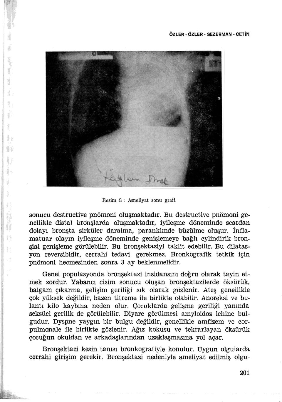 İnflamatuar olayın iyileşme döneminde genişlemeye bağlı cylindirik bronşial genişleme görülebilir. Bu bronşektaziyi taklit edebilir. Bu dilatas.. yon reversi'bldir, cerrahi tedavi gerekınez.