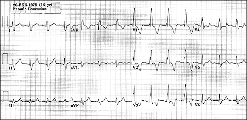 Dal Blokları 1.Sağ Dal Bloğu -AV düğümle His Demeti Arasında Blok Oluşması, Dal Bloklarına sebep olur- QRS >0.