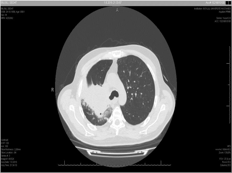 Nivolumab Öncesi ve