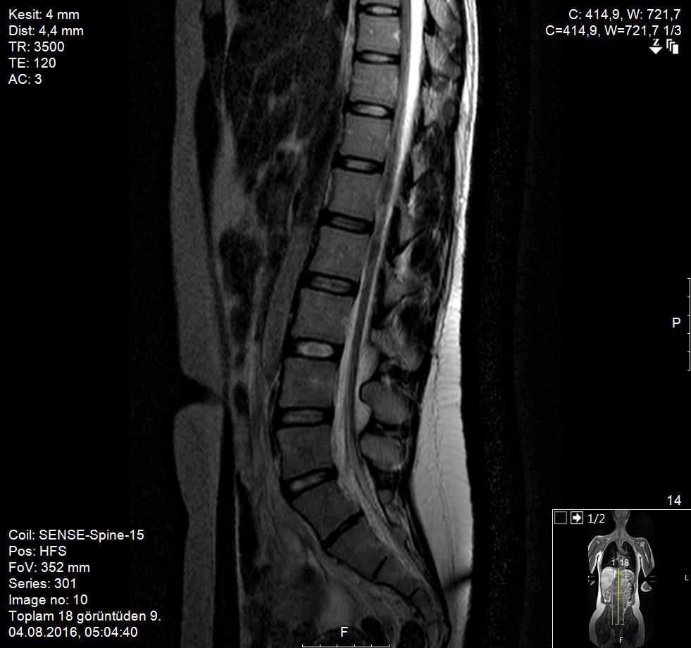 SPİNAL MR Orbita ve tüm spinal