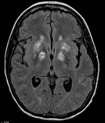 Kriptokok infeksiyonu Meningeal veya parankimal tutulum Perivasküler alana yayılım Bazal ganglionları tutan parankimal Kriptokokoma: nadir BT Diffüz