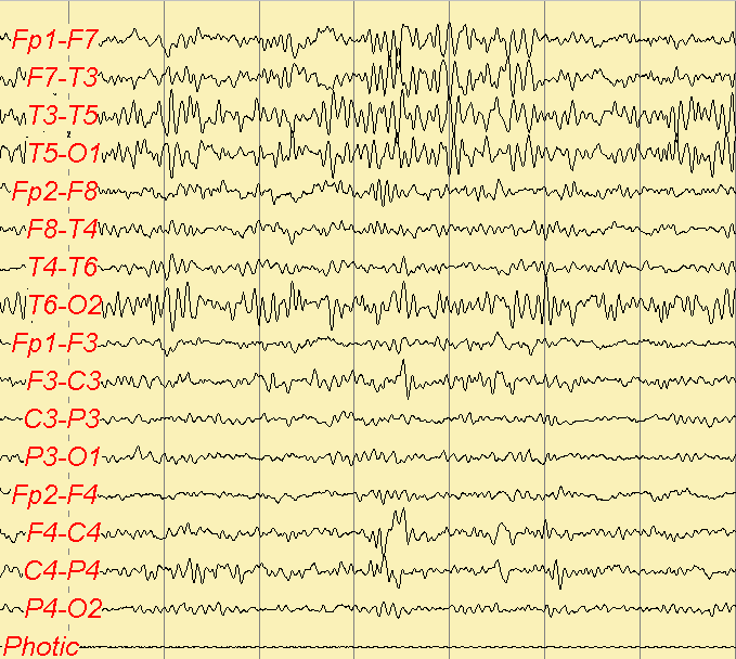 Şekil 5 de 1 ve 54 nolu hastalarımıza ait EEG kayıtları gösterilmektedir (A ve B).