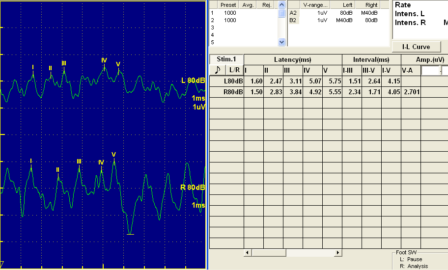 AÜTF Pediatrik Nöroloji Laboratuvarında teknisyenler (Hediye ZEYBEK, Selda KAYMAK) tarafından Nihon Kohden marka cihaz ile ulaşılabilen hastalarda kaydedilen BAER dalgalarının latansları deneyimli