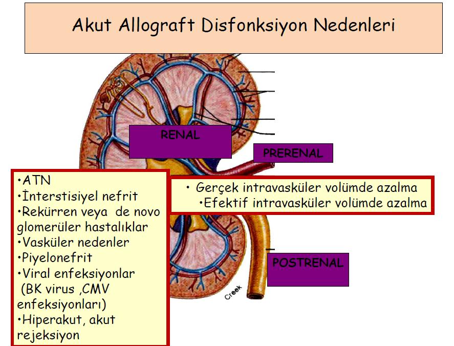 Akut Greft Disfonksiyonu Ayırıcı Tanı RENAL PRERENAL POSTRENAL