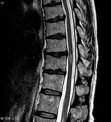 An MRI showing lesion of Transverse myelitis (the