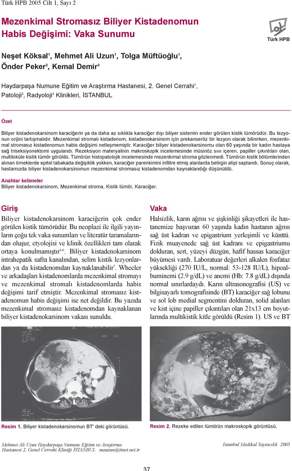 Genel Cerrahi 1, Patoloji 2, Radyoloji 3 Klinikleri, ÝSTANBUL Özet Biliyer kistadenokarsinom karaciðerin ya da daha az sýklýkla karaciðer dýþý biliyer sistemin ender görülen kistik tümörüdür.