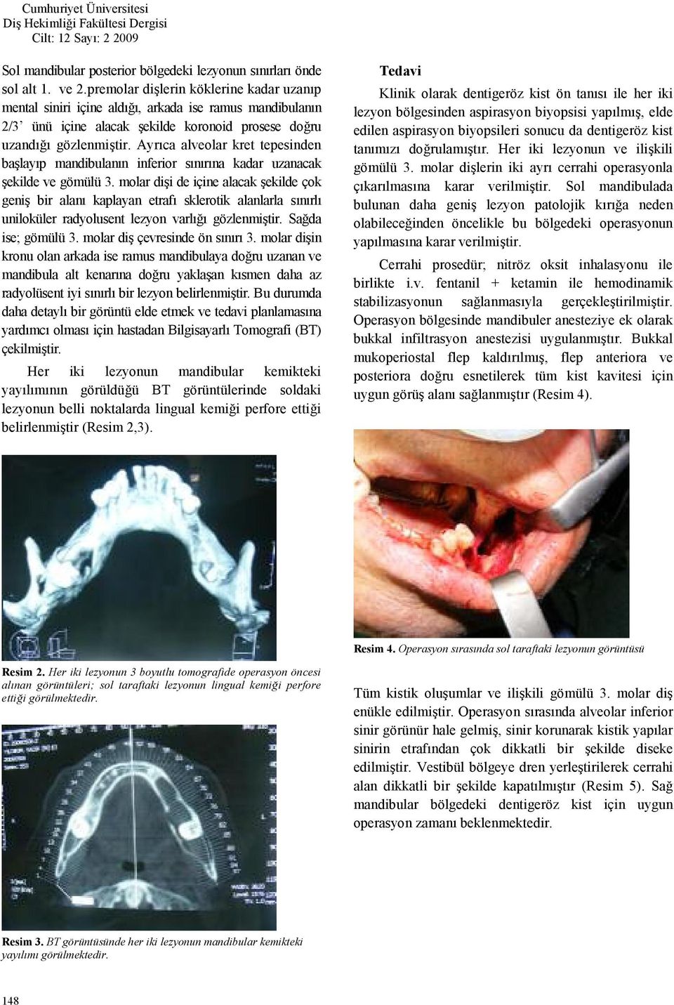 Ayrca alveolar kret tepesinden balayp mandibulann inferior snrna kadar uzanacak ekilde ve gömülü 3.