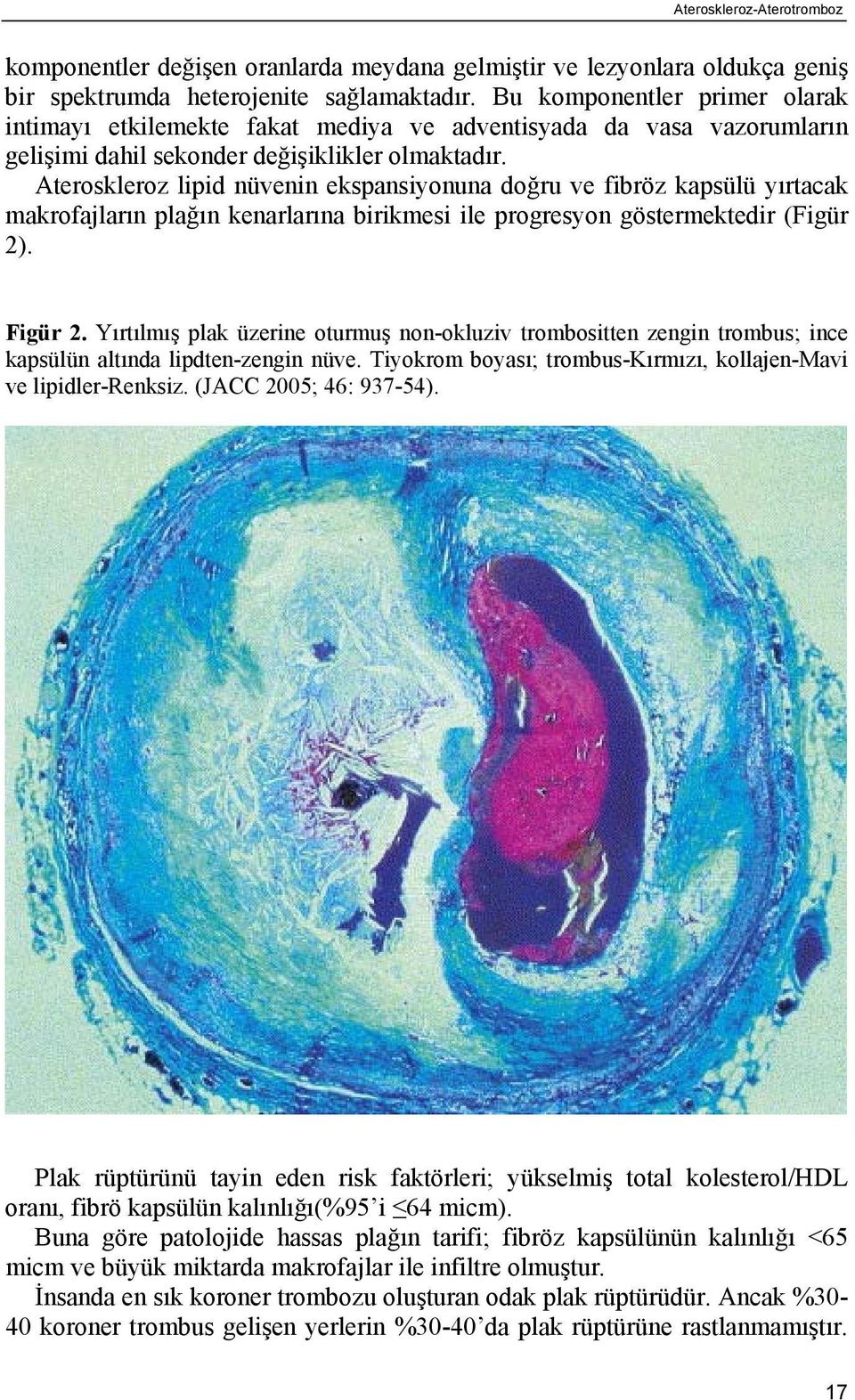 Ateroskleroz lipid nüvenin ekspansiyonuna doğru ve fibröz kapsülü yırtacak makrofajların plağın kenarlarına birikmesi ile progresyon göstermektedir (Figür 2). Figür 2.