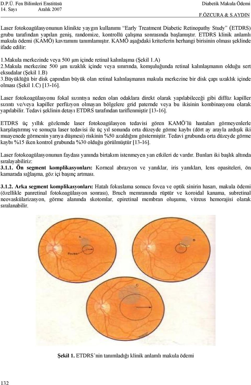 Makula merkezinde veya 500 µm içinde retinal kalınlaşma (Şekil 1.A) 2.Makula merkezine 500 µm uzaklık içinde veya sınırında, komşuluğunda retinal kalınlaşmanın olduğu sert eksudalar (Şekil 1.B) 3.