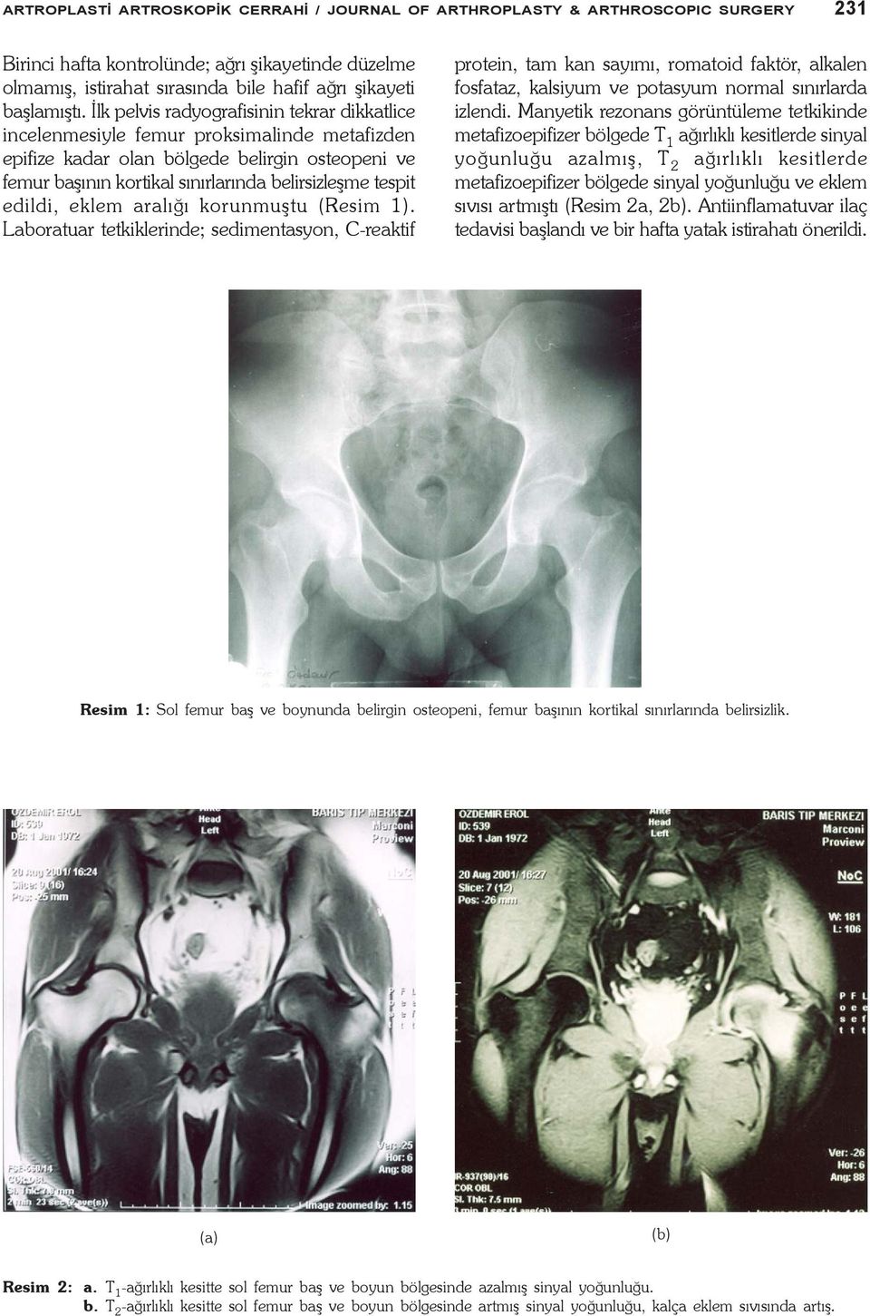 Ýlk pelvis radyografisinin tekrar dikkatlice incelenmesiyle femur proksimalinde metafizden epifize kadar olan bölgede belirgin osteopeni ve femur baþýnýn kortikal sýnýrlarýnda belirsizleþme tespit