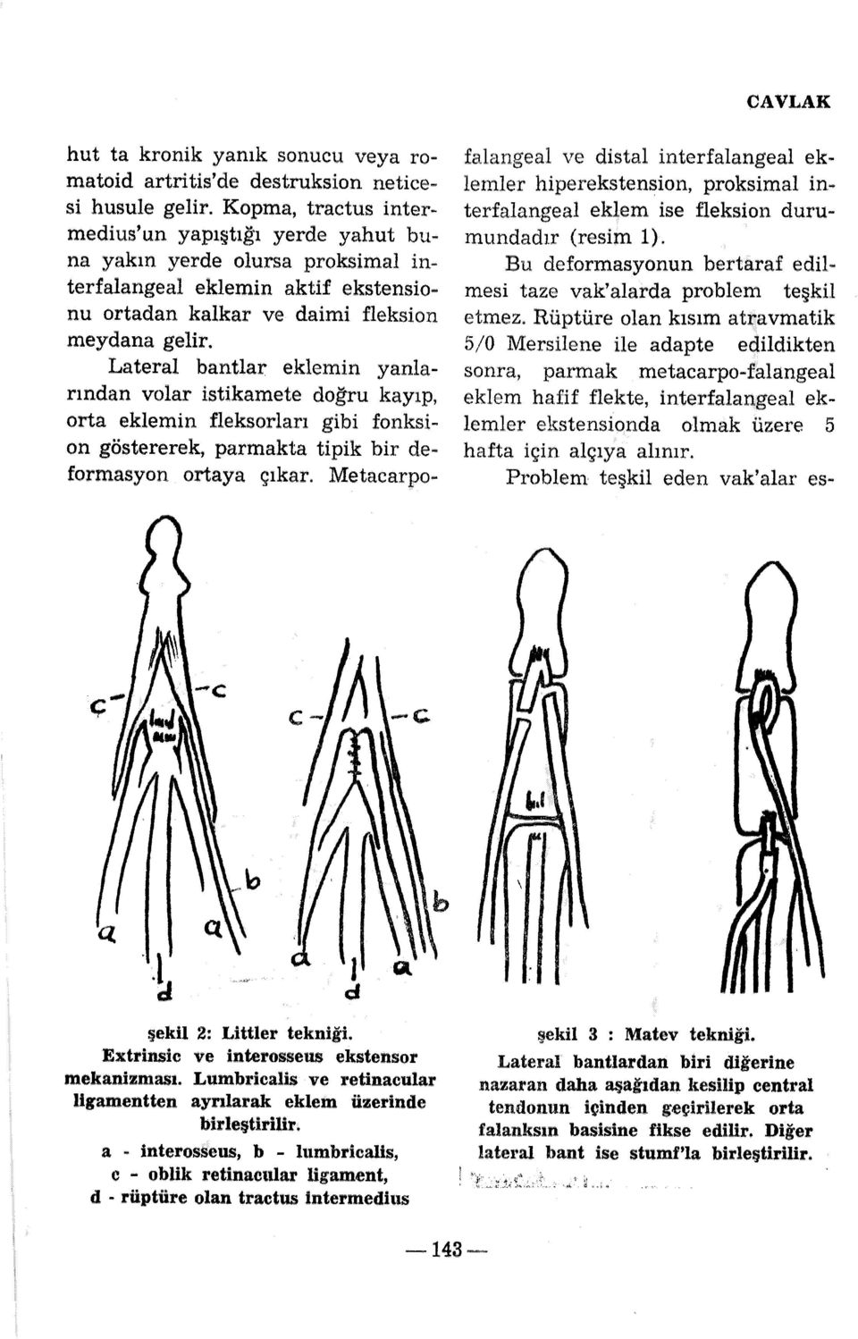 Lateral bantlar eklemin yanlarından volar istikamete doğru kayıp, orta eklemin fleksorları gibi fonksion göstererek, parmakta tipik bir deformasyon ortaya çıkar.