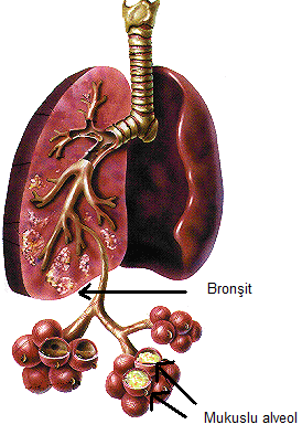 Belirti ve Bulgular Öksürük, Balgam, Ateş, Hemoptizi, (kan tükürme) Göğüste