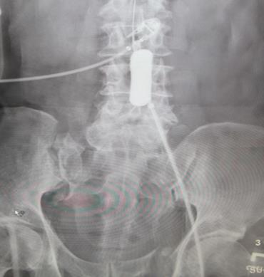 Noncompressible torso hemorrhage (NCTH)