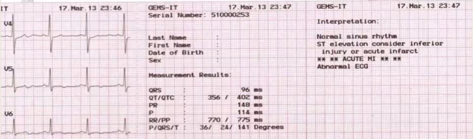 Kontrol EKG- 22 dk sonra Saat 11:46 DIII de Q dalgası büyümüş, ST