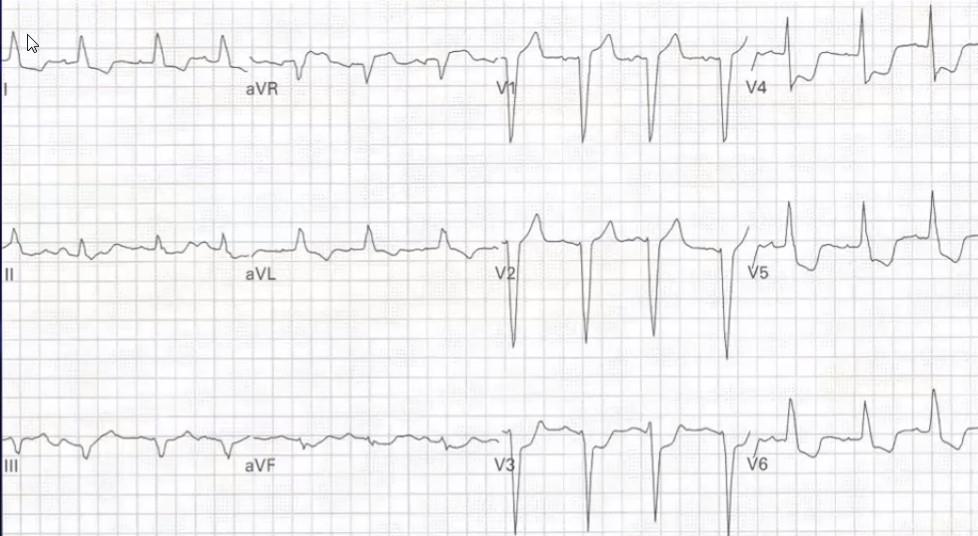 Sgarbossa