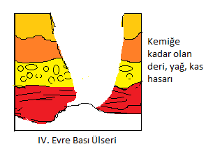 43 Şekil 1.2: Bası Ülseri Evreleri Deri Değerlendirilmesi Bası ülseri görülme sıklığını azaltmada kapsamlı ve aralıklı deri değerlendirilmesinin önemli rolü vardır (5,6).