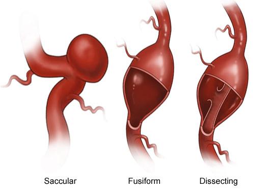 Anevrizmalar Arterin patolojik genişlemesi SAK--Yaşam süresince en kötü baş ağrısı Sınıflama