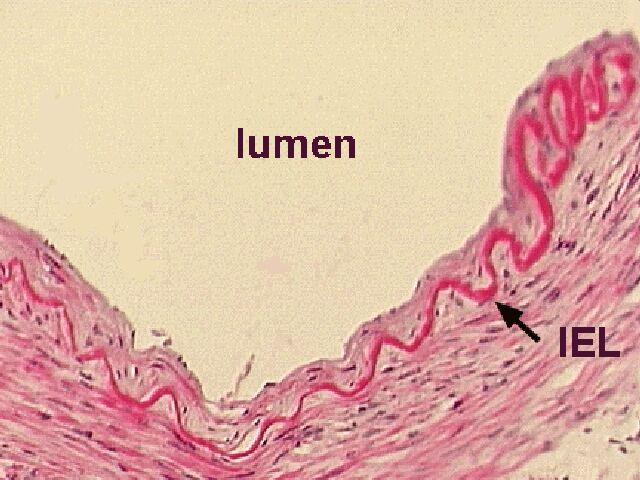 Anevrizmalar Patogenez Nedeni tam bilinmiyor Serebral arterler farklı Diğer arterlere göre ince İnternal elastik lamina yok Media