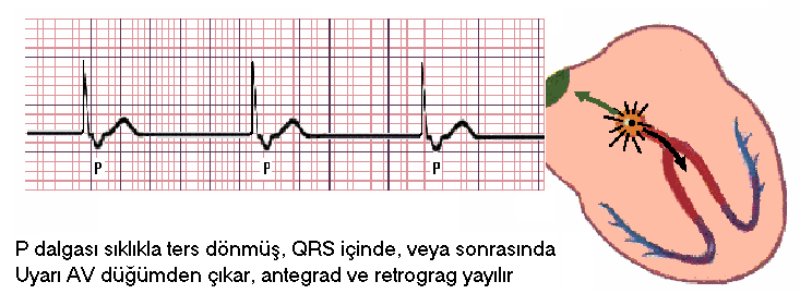 Nodal ritim Sinüsten uyarı çıkışının yetersiz olduğunda kaçış ritmi olarak ortaya çıkar