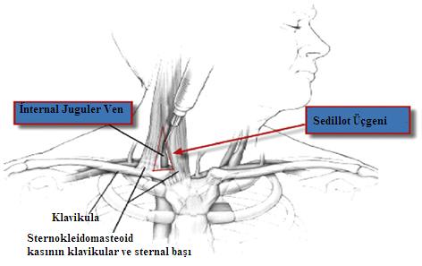 Sternokleidomastoid kasın klaviküler ve sternal bacaklarının oluşturduğu üçgenin apeksi de ponksiyon noktası olarak kullanılabilir.