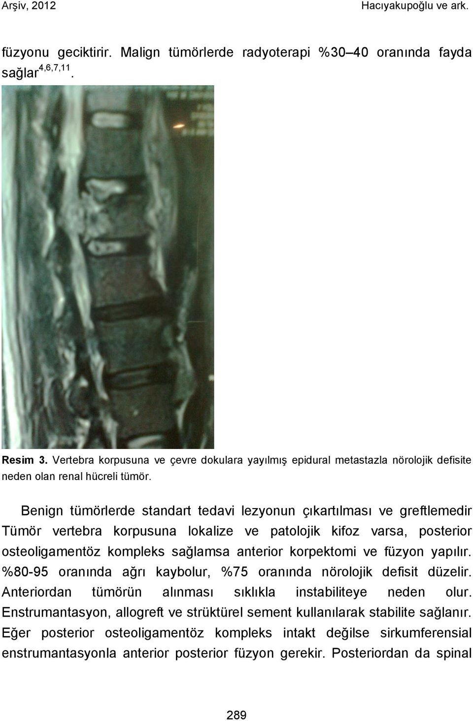 Benign tümörlerde standart tedavi lezyonun çıkartılması ve greftlemedir Tümör vertebra korpusuna lokalize ve patolojik kifoz varsa, posterior osteoligamentöz kompleks sağlamsa anterior korpektomi ve