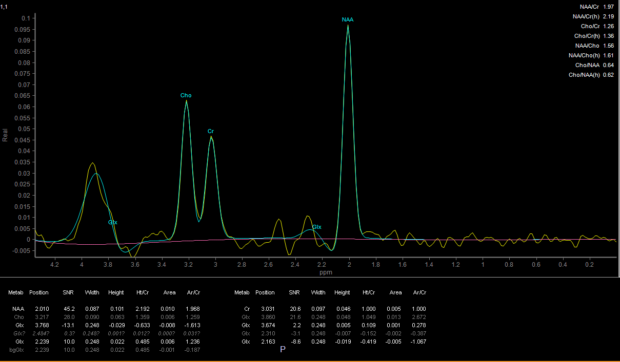 Şekil 2: 1 H-MRS uygulaması ile elde edilen DLPFK bölgesinin metabolit değerleri ve oluşan tepe değerlerin grafik gösterimi.